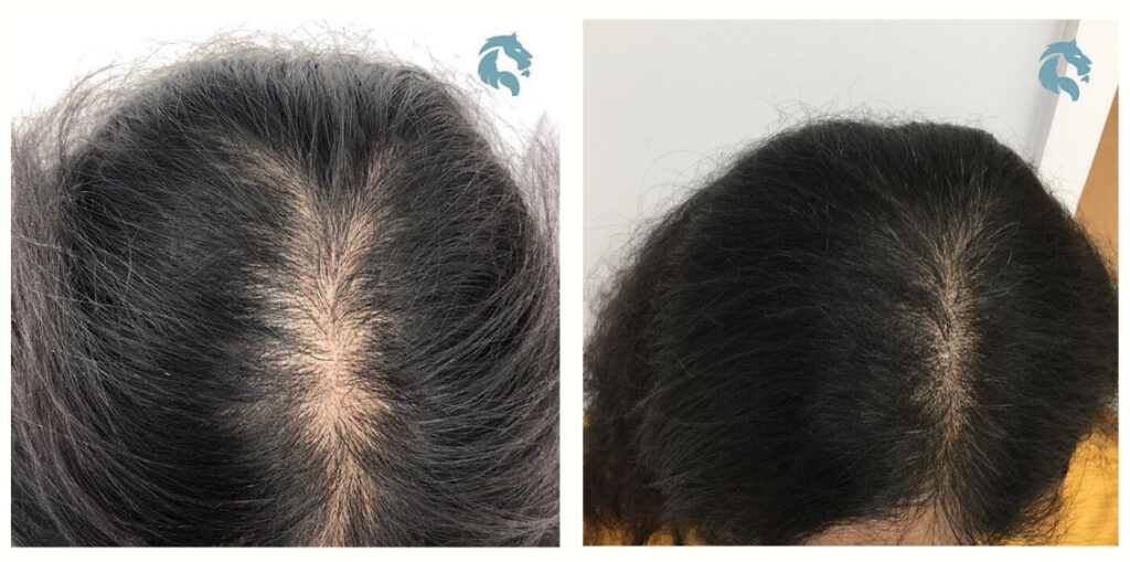 PRP-Injection-for-Hair-Loss-Before-and-After