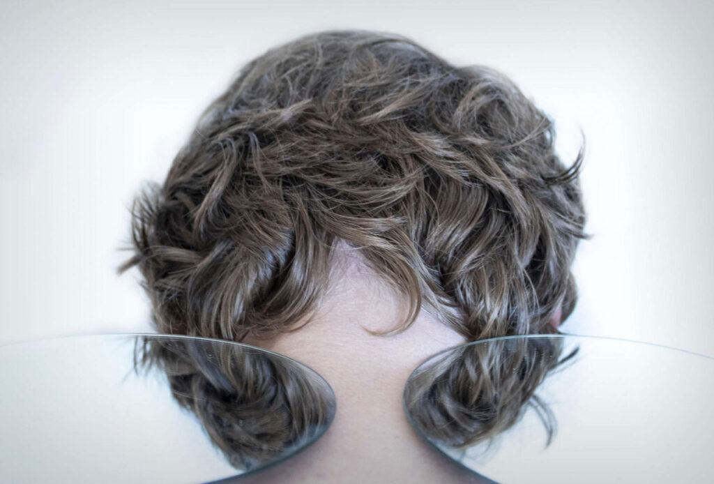 Should-I-Get-A-Hair-Transplant