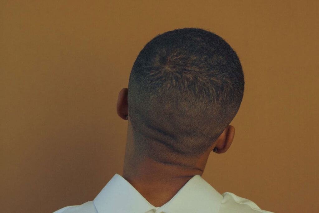 FUE-Hair-Transplant-Aftercare
