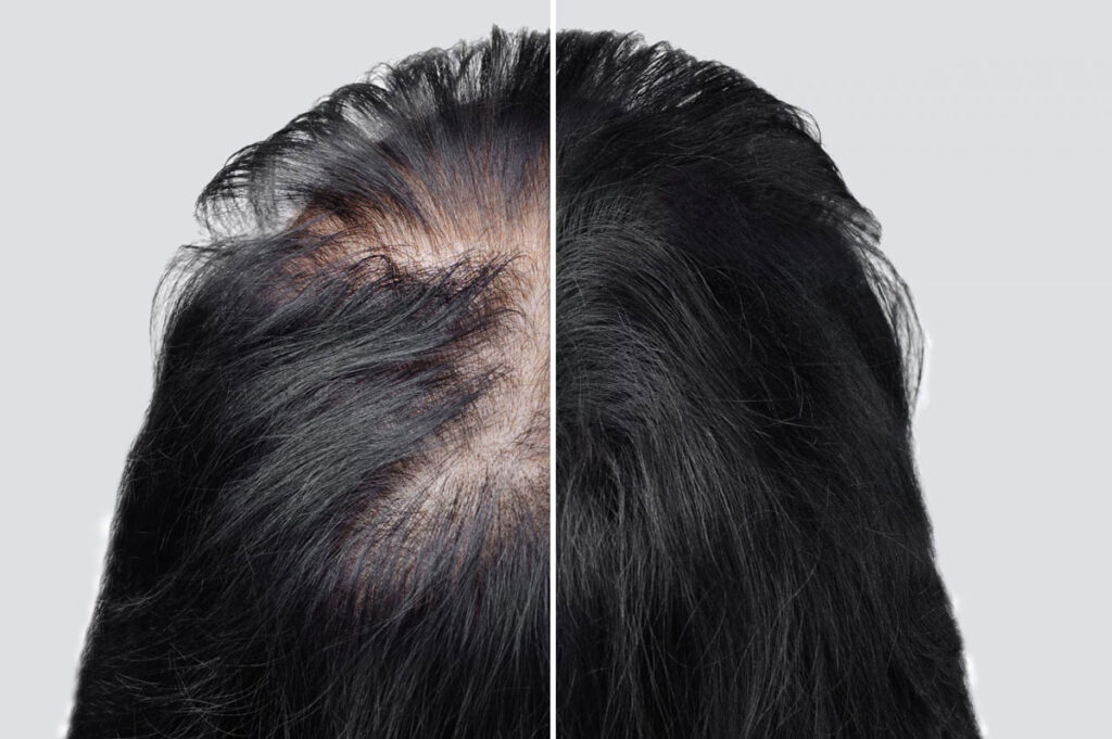 Crown Hair Transplant