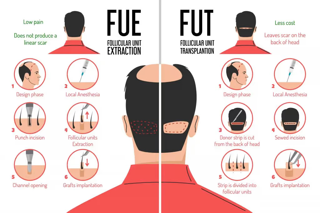 Fue vs FUT hair transplant