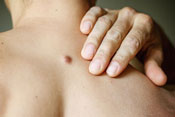 Cyst-Removal