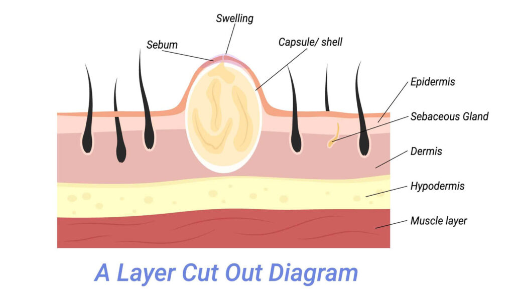 Popping-a-Sebaceous-Cyst