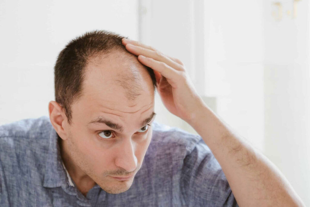 male-pattern-baldness