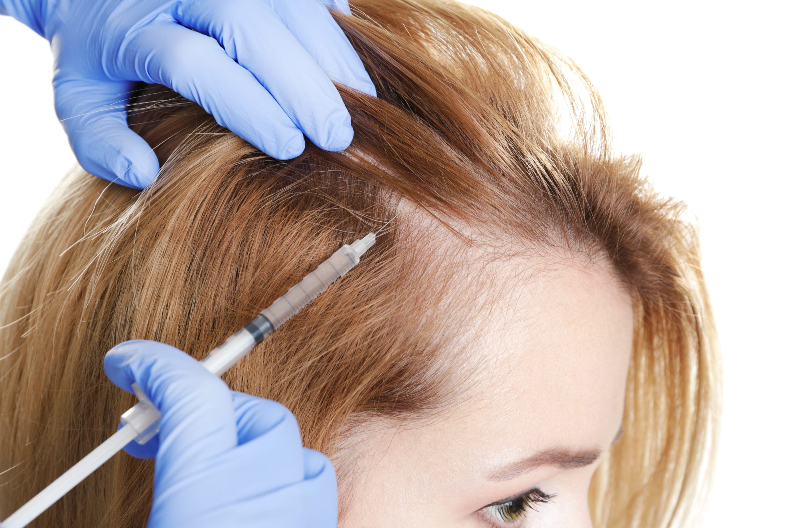 Female Celebrities Who Have Had Hair Transplants