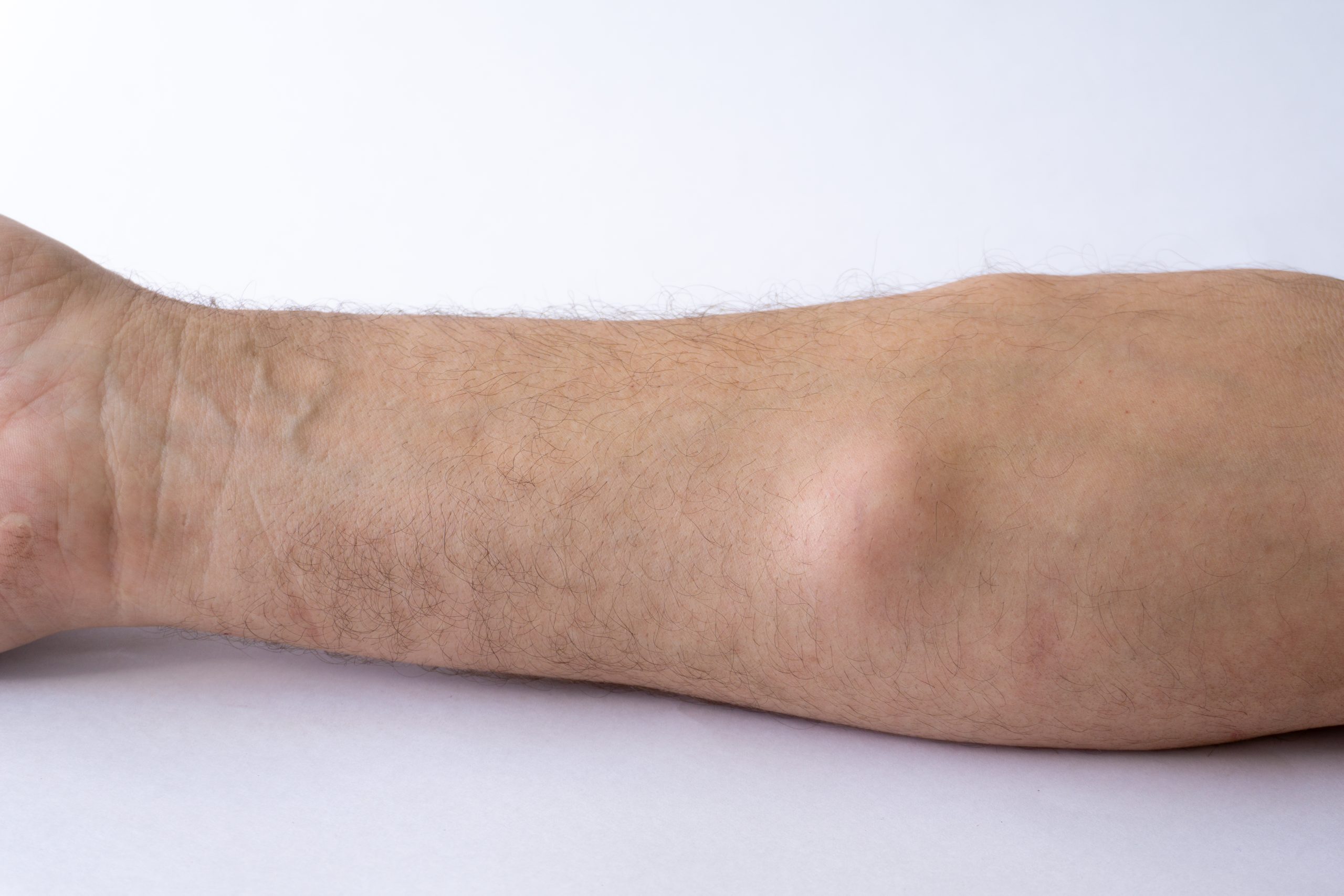 lipoma liposarcoma