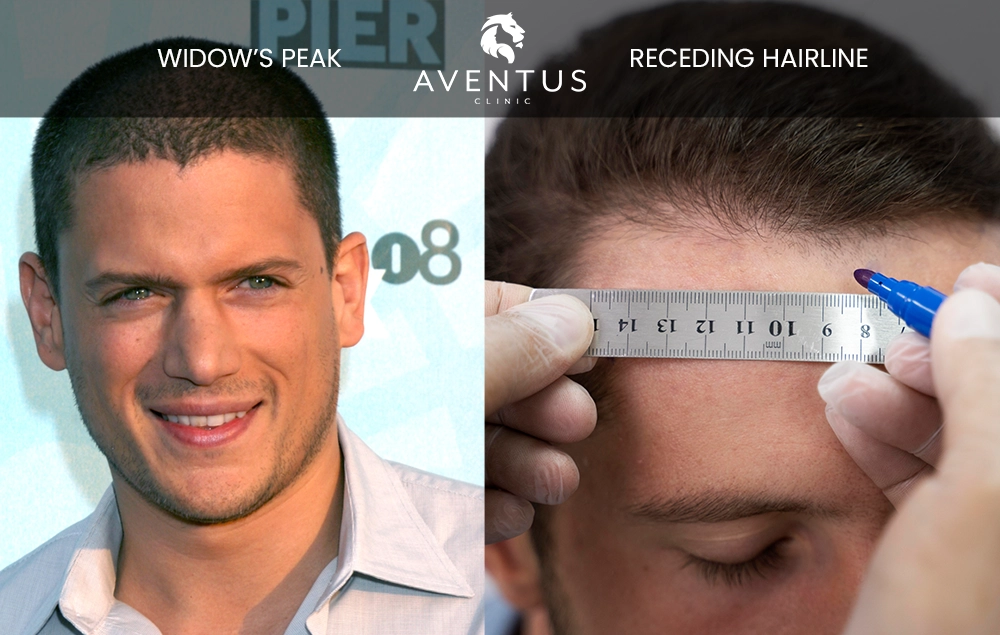 widow's peak vs receding hairline