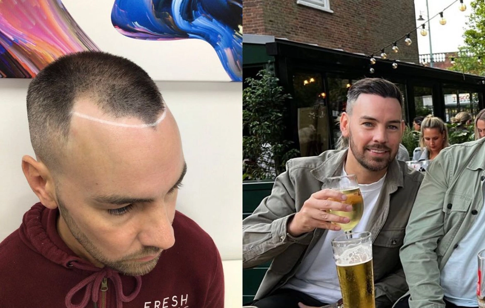 Photo of a before and after a hairline transplant