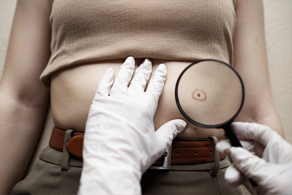 A woman having a mole check by a dermatologist