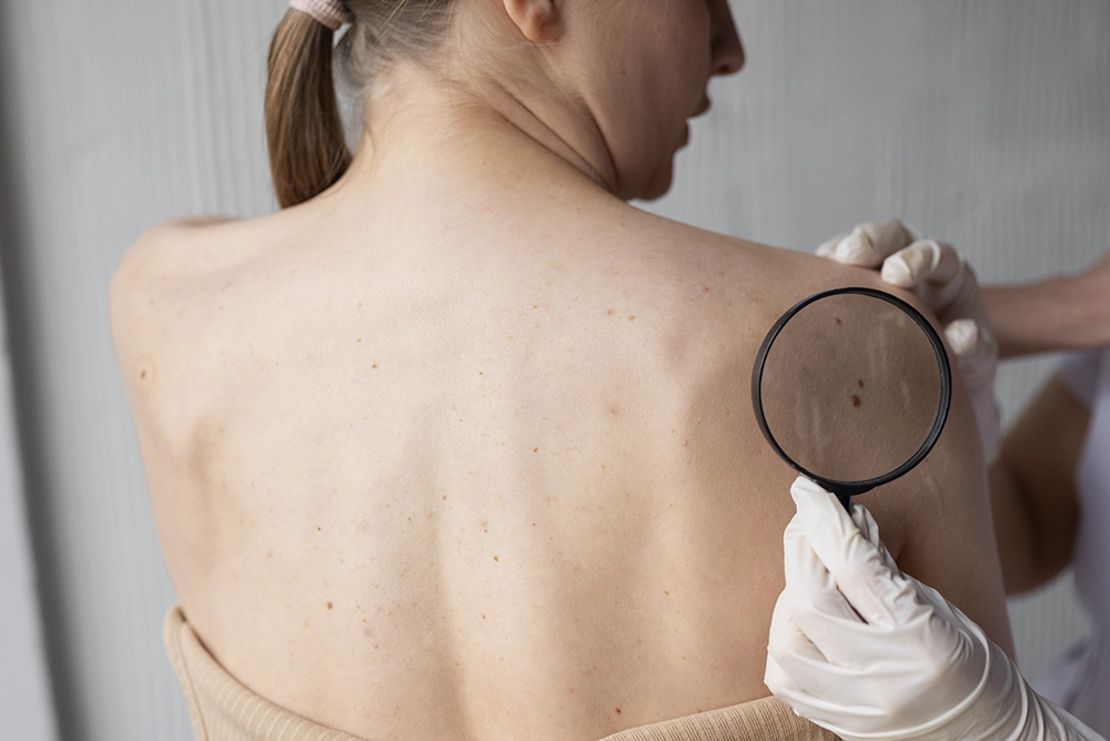 Moles on a womans back