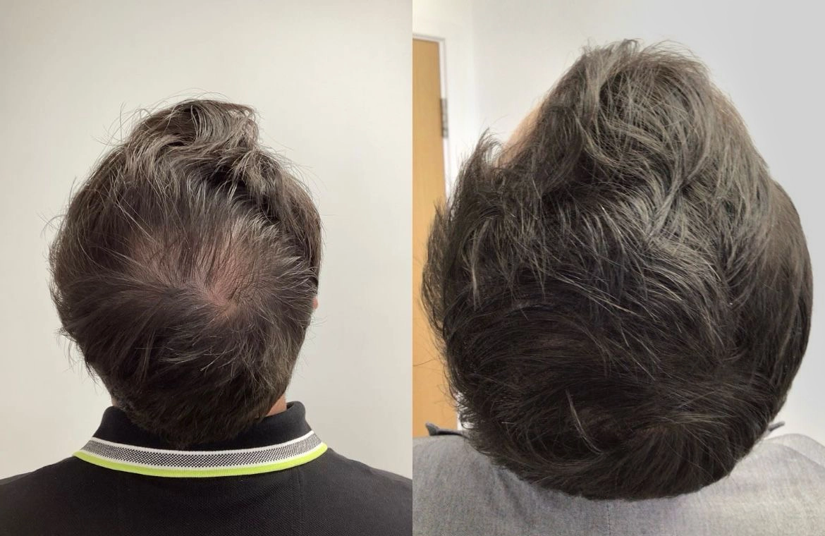 Non Surgical Hair Treatment Before And After