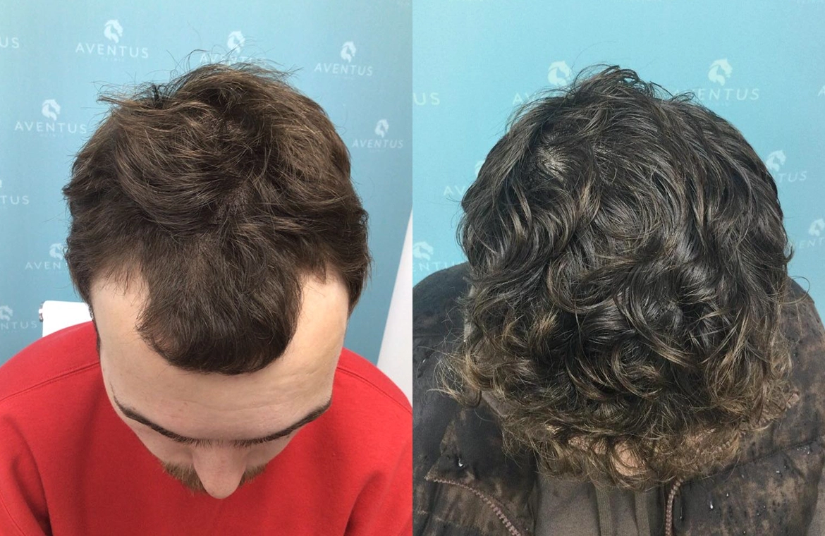 Non Surgical Hair Treatment Before And After2
