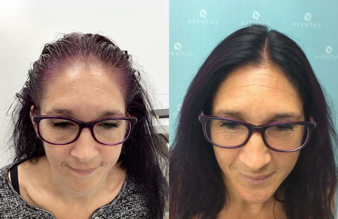 Non Surgical Hair Treatment Before And After3