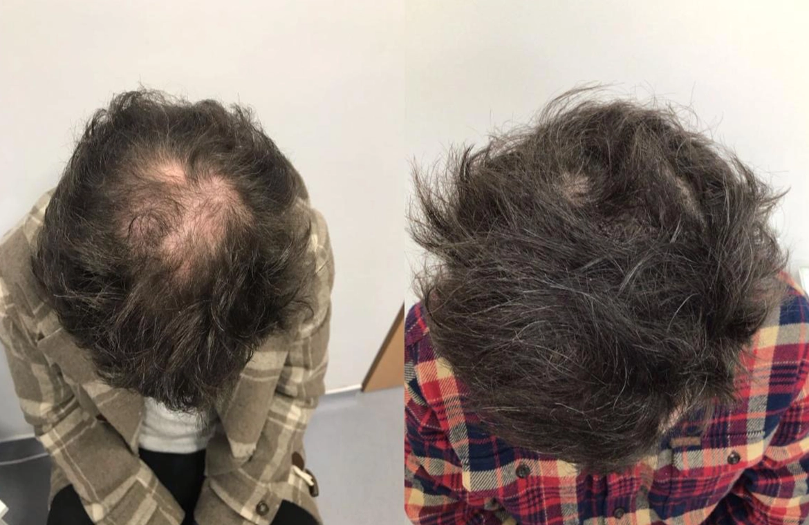 Non Surgical Hair Treatment Before And After4