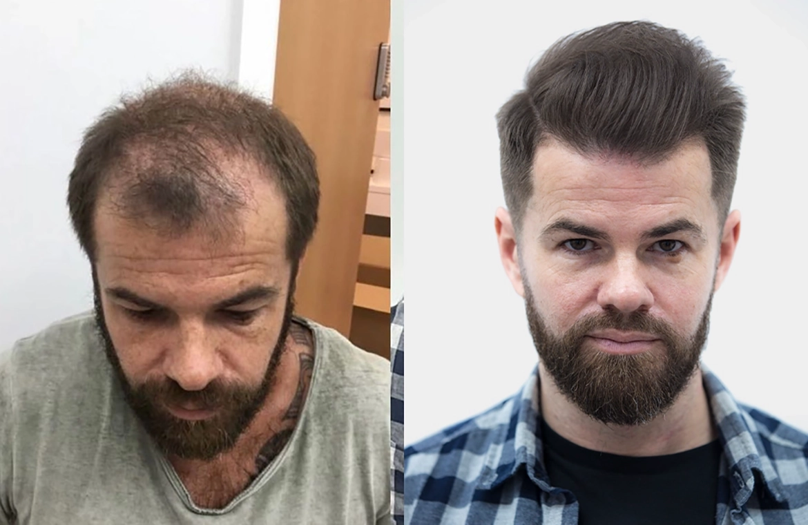 Hair Loss Before And After 2