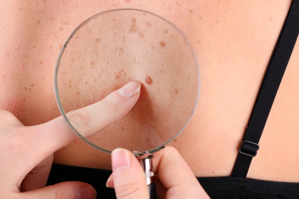 Dermatologist Skin Check