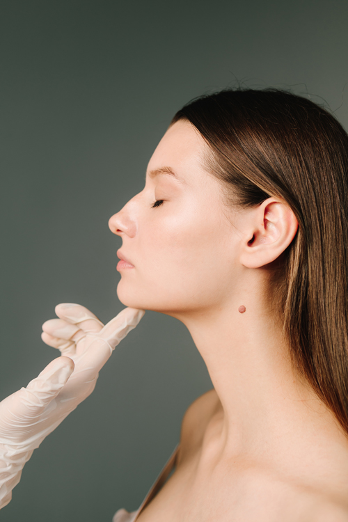 Mole Removal