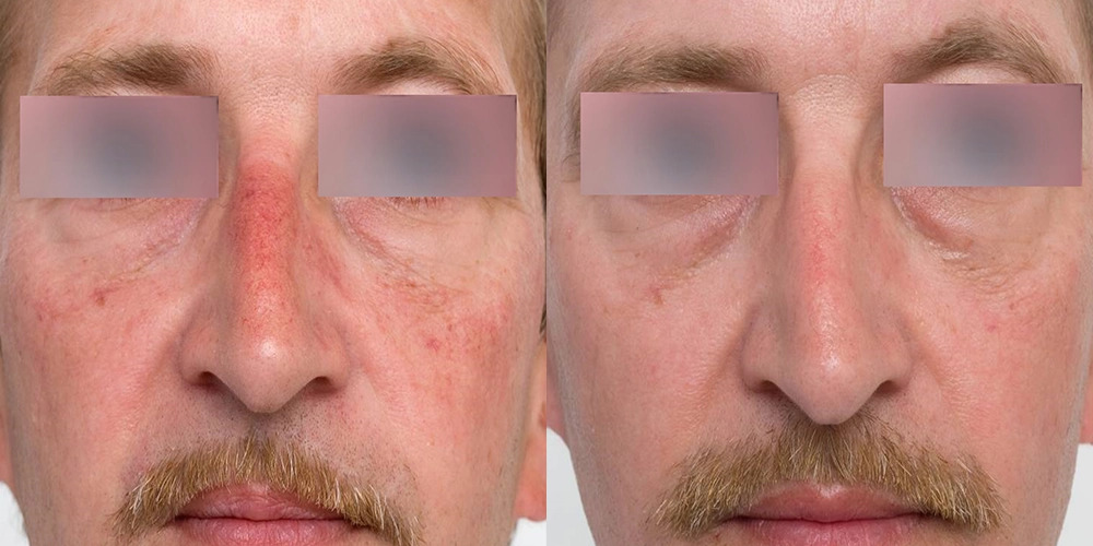 Nordly-Before-And-After-1