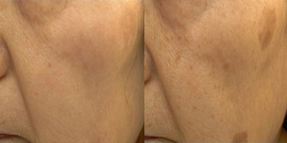 Nordly-Before-And-After-3