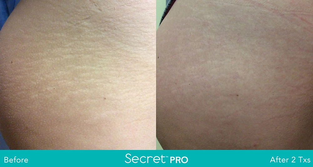 Secret-Pro-Before-And-After2