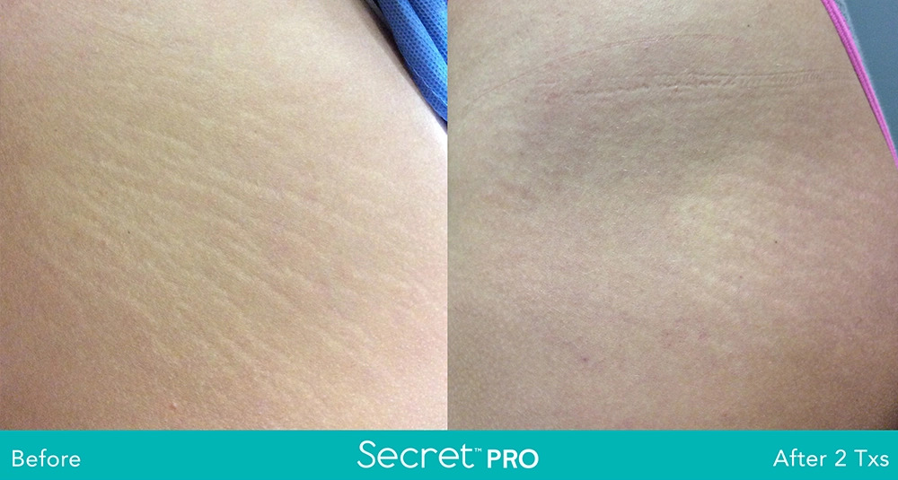 Secret-Pro-Before-And-After3