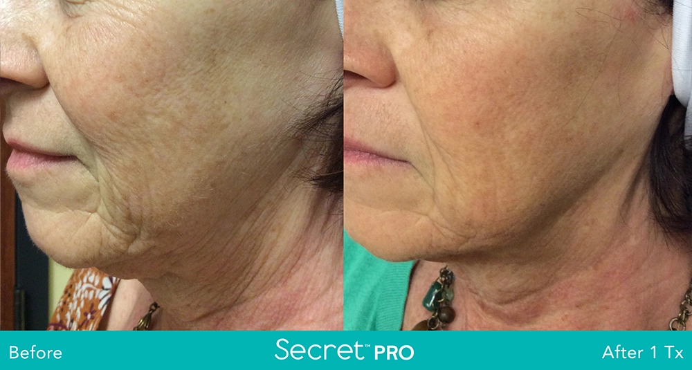 Secret-Pro-Before-And-After4