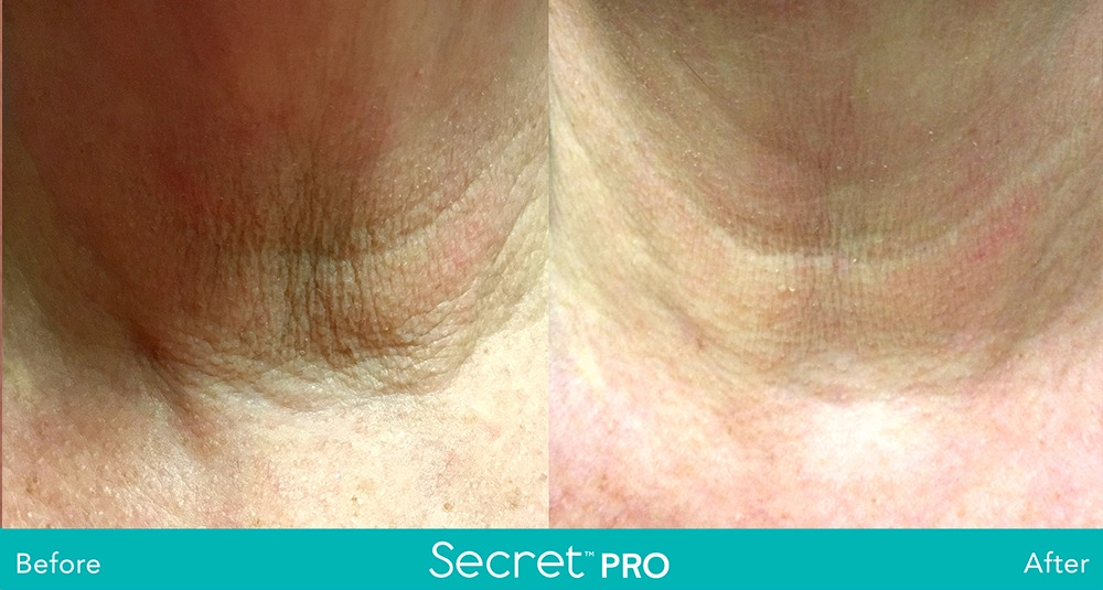 Secret-Pro-Before-And-After6