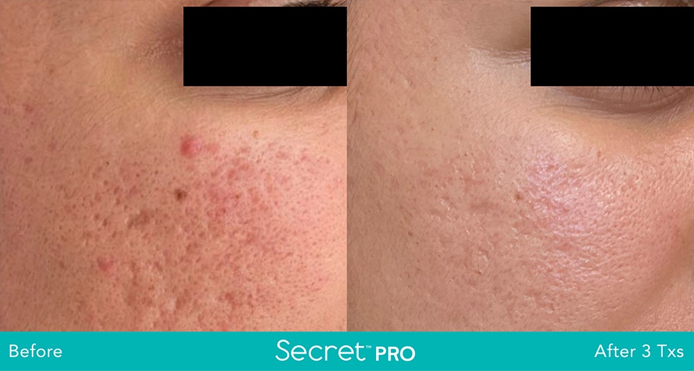 Secret-Pro-Before-And-After7