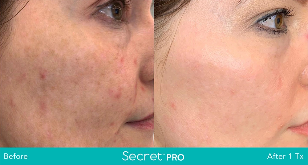 Secret-Pro-Before-And-After9