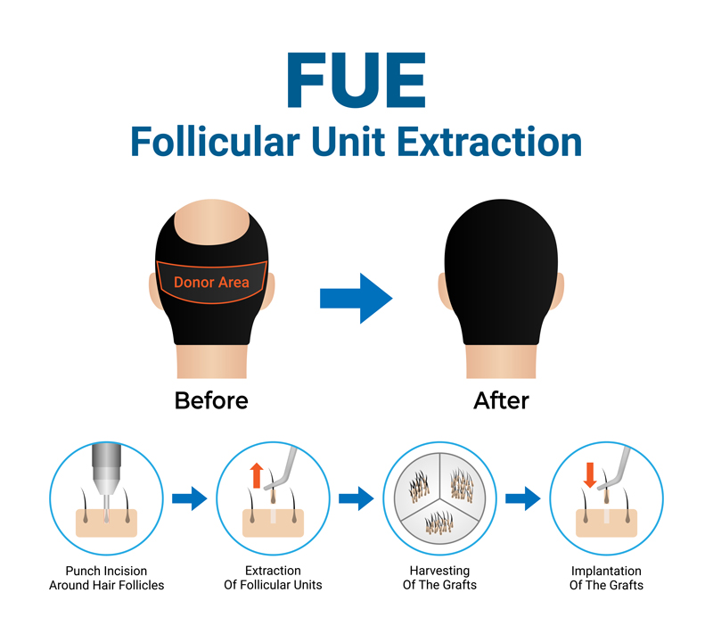 follicular_unit_extraction.jpg