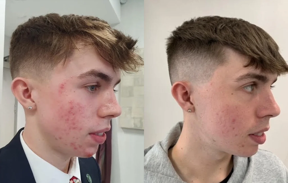 Acne-Before-And-After2