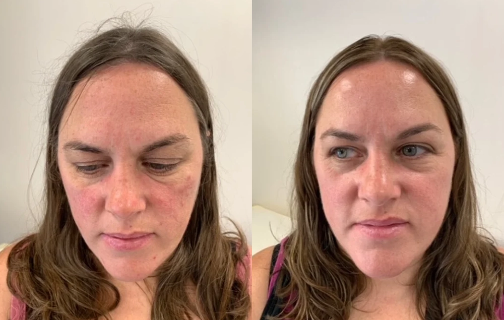 Acne-Before-And-After4