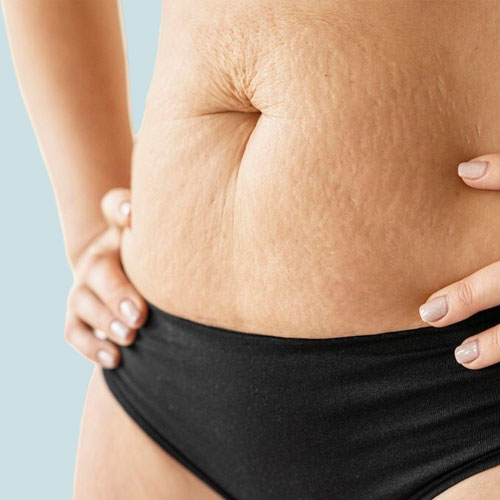 Lipoma Removal Treatment