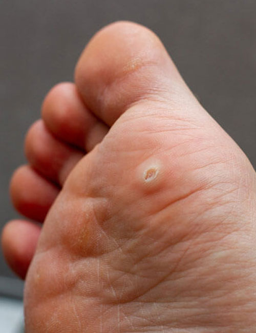 Warts