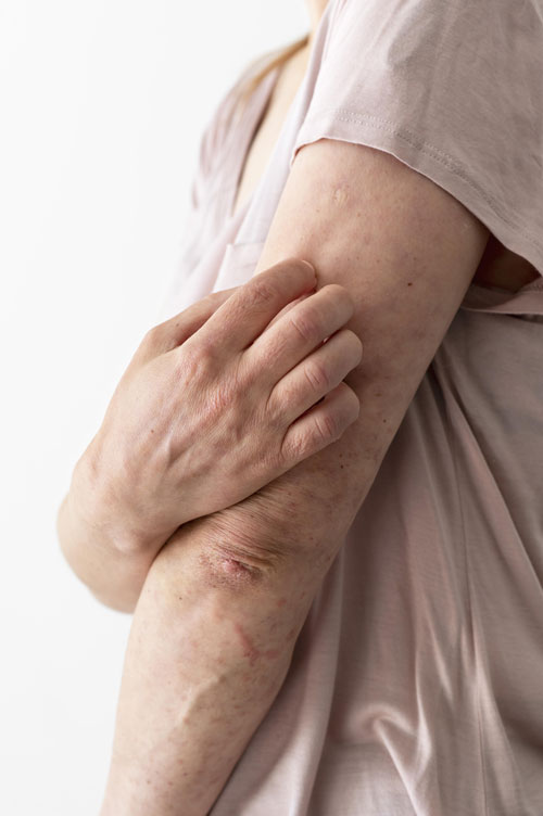 fibroma