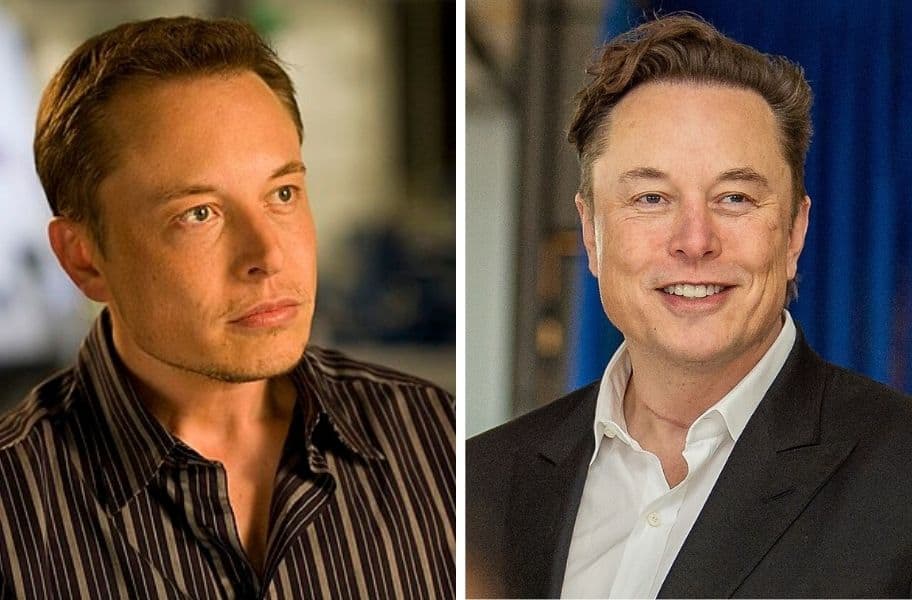 Elon Musk Hair Transplant