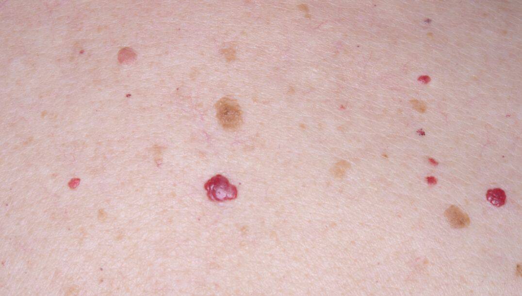 Cherry Angioma