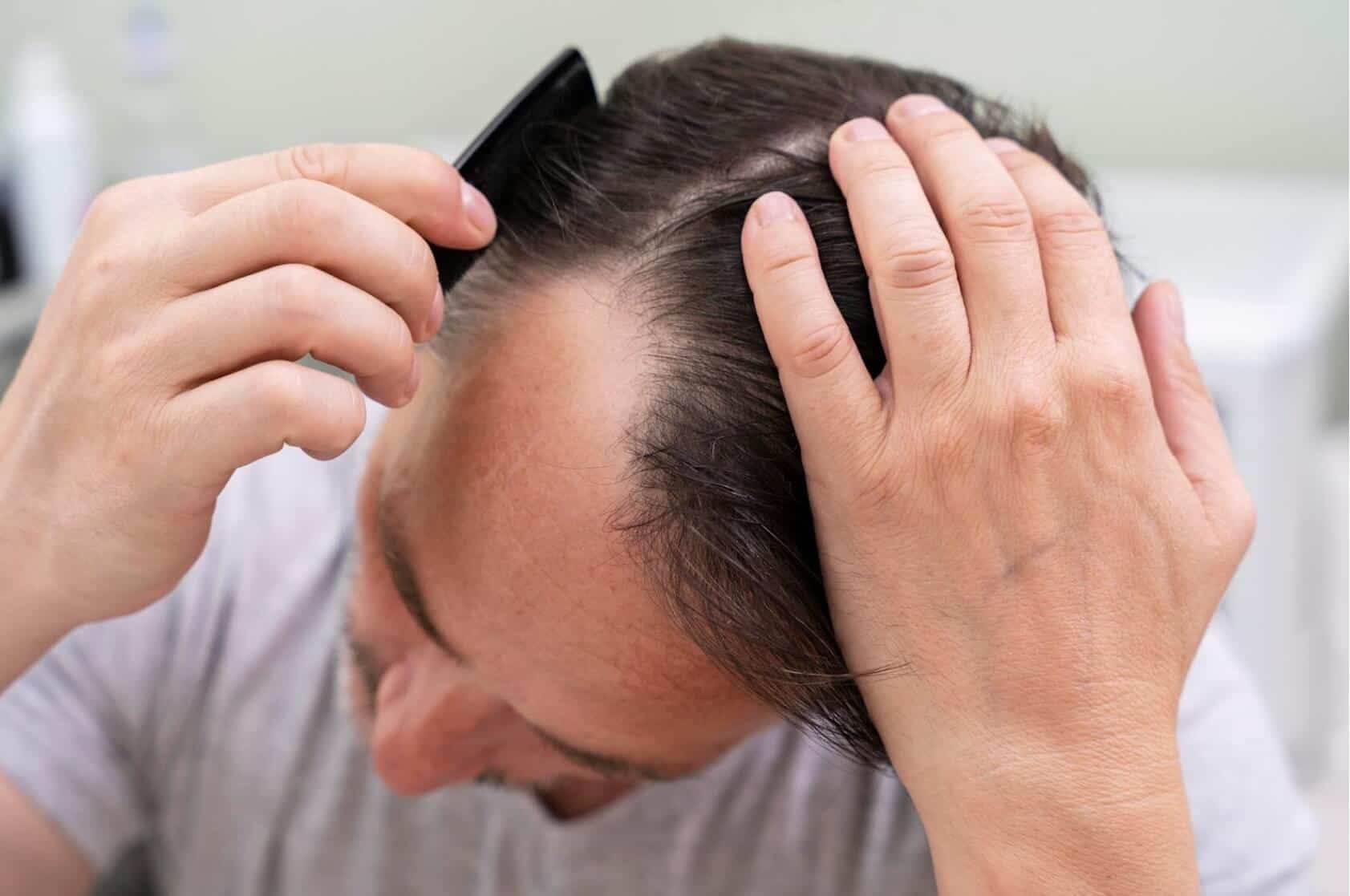 Steroid Hair Loss