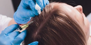 PRP For Hair Loss