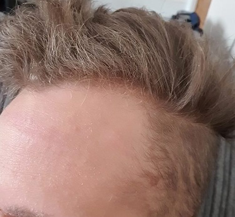 After Forehead Cyst Removal