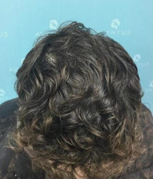 After non surgical hair treatment 2