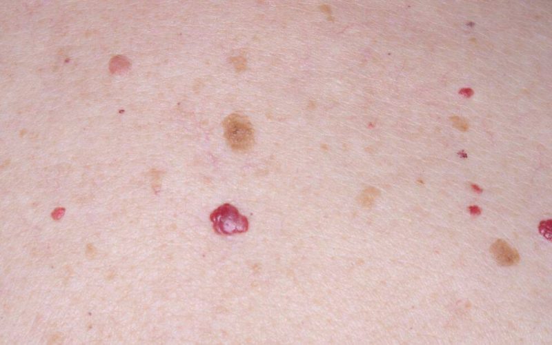 Cherry Angioma