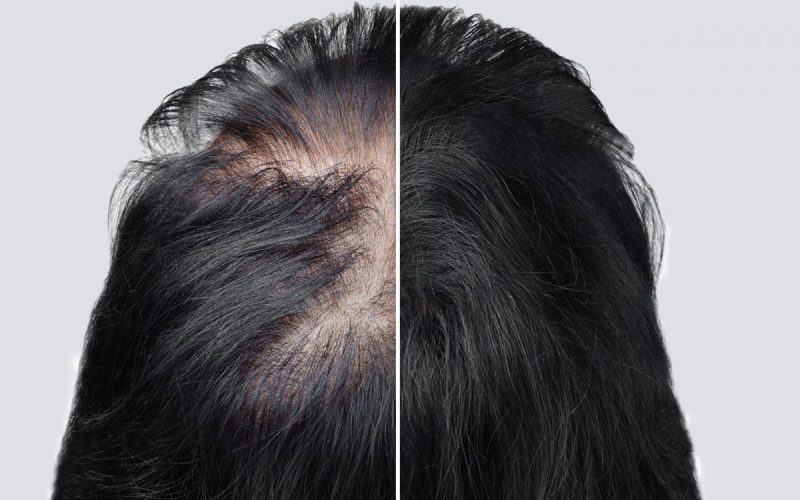 Crown Hair Transplant