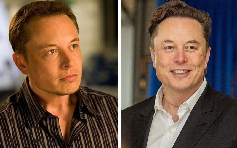 Elon Musk Hair Transplant