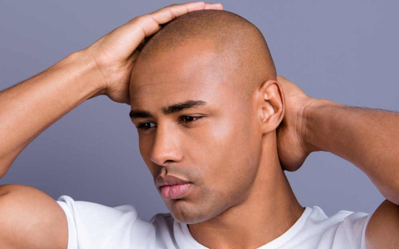 FUE Hair Transplant FAQ