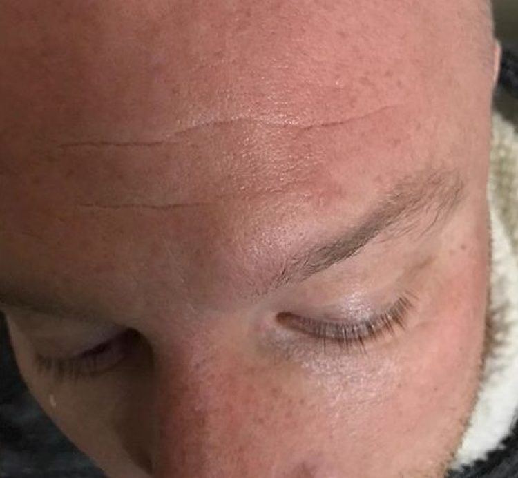 Forehead Cyst After Removal