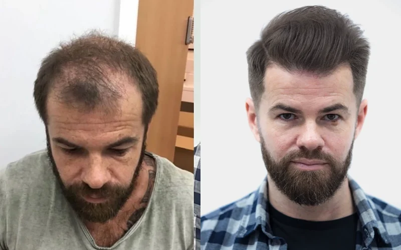 Hair Loss Before And After 2