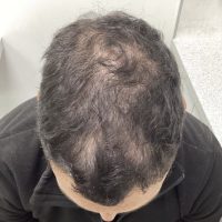 before non surgical hair treatment 3