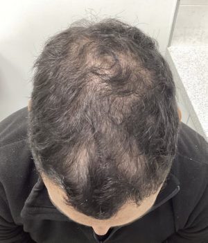 before non surgical hair treatment 3