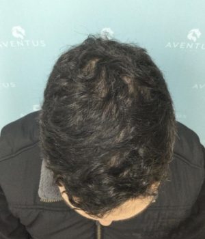 after non surgical hair treatment 2